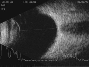 B-Scan Ocular Ultrasound